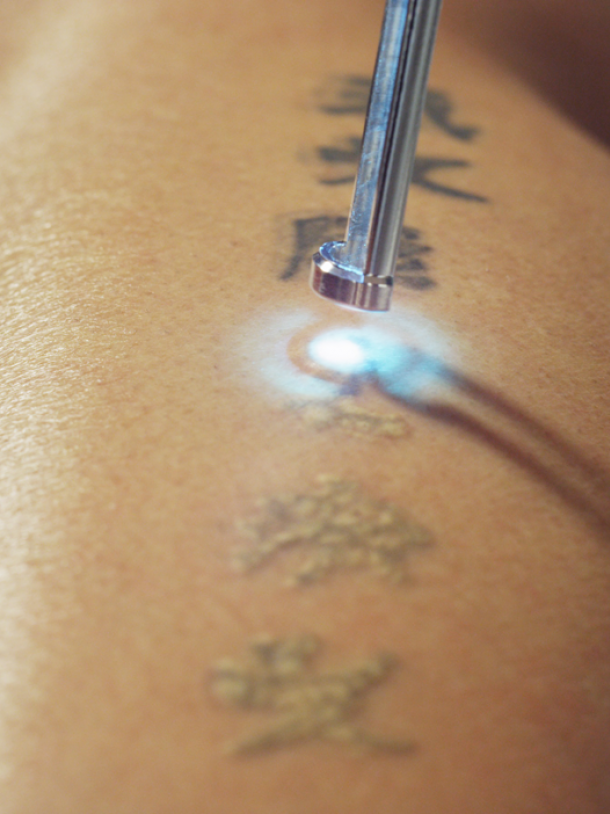 A Guide to Everything You Should Know About Tattoo Removal